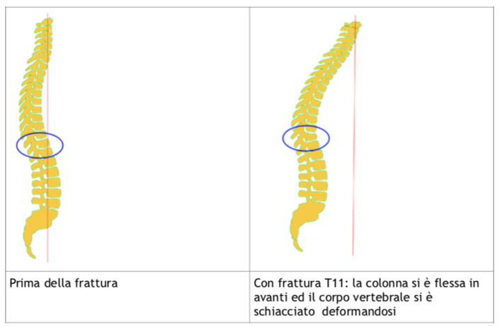 fratture da osteoporosi