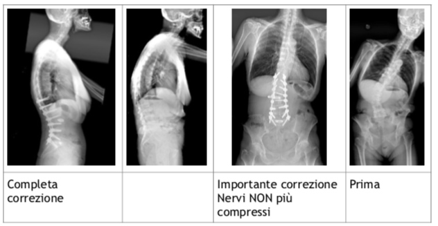 scoliosi intervento