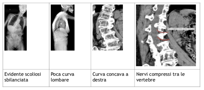 scoliosi